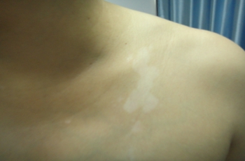 胸部白癜风患者早期症状表现