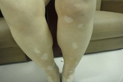 北京治疗白癜风的医院：肢端型白癜风如何护理